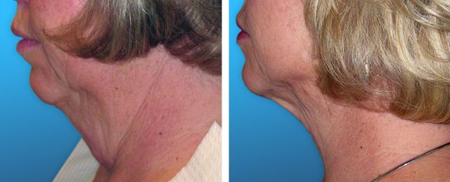 Before After - Liposuccion cou