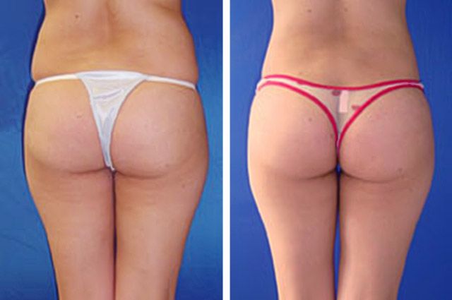 Before After - Liposuccion des flans et des hanches