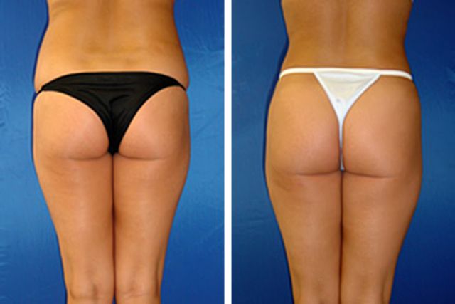 Before After - Liposuccion des flans et des hanches