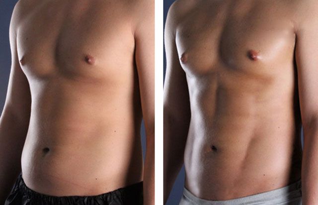 Before After - Liposuccion tablette de chocolat