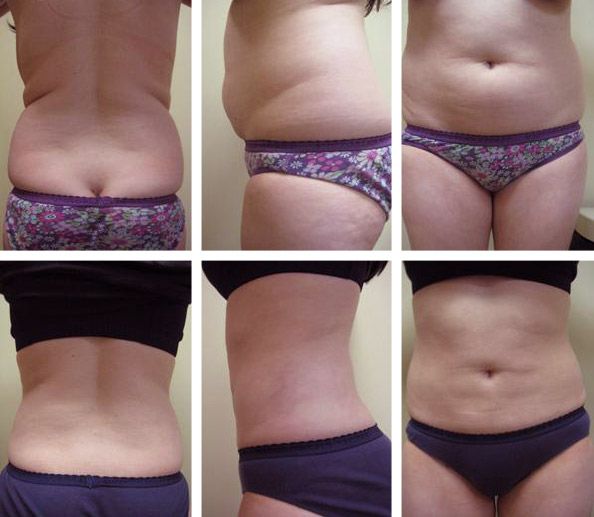 Before After - Liposuccion du torse