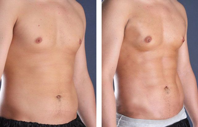 Before After - Liposuccion tablette de chocolat