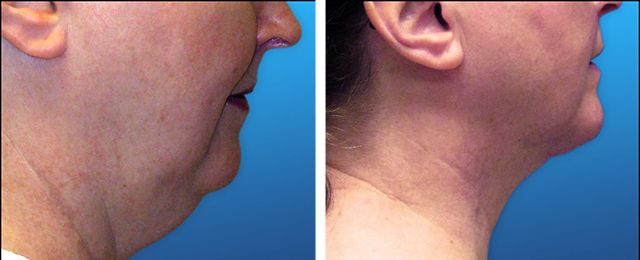 Before After - Liposuccion cou