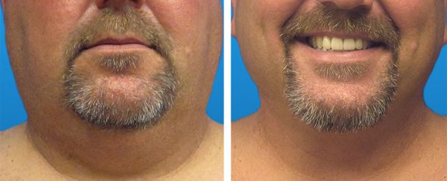 Before After - Liposuccion du cou