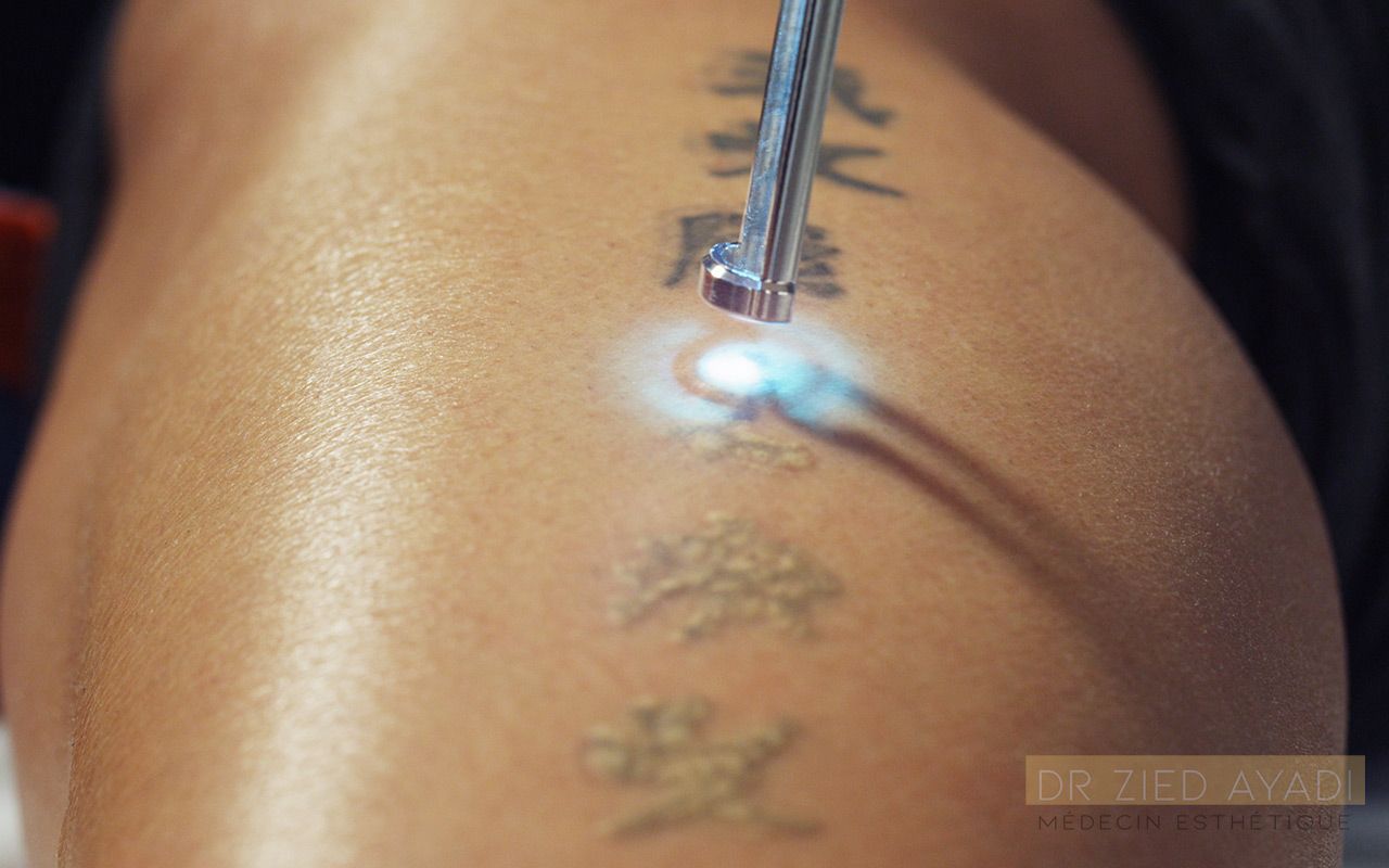 Détatouage Laser