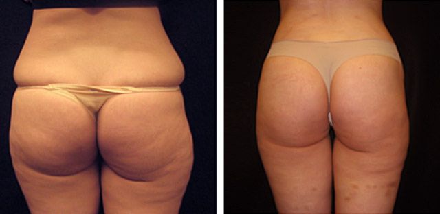 Before After - Liposuccion des flans et des hanches