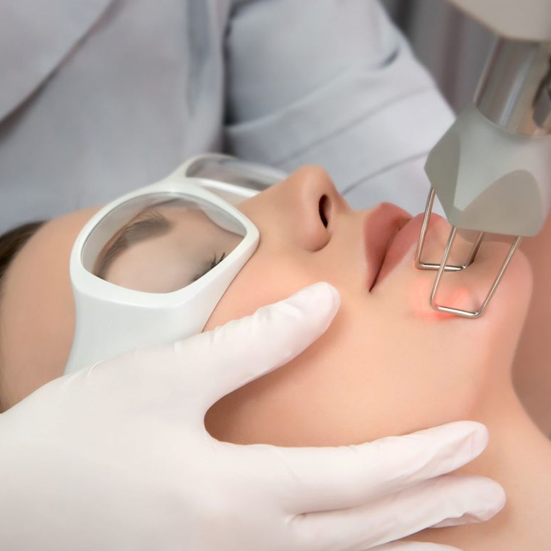 Body Smartlipo Cynosure