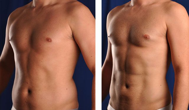 Before After - Liposuccion tablette de chocolat