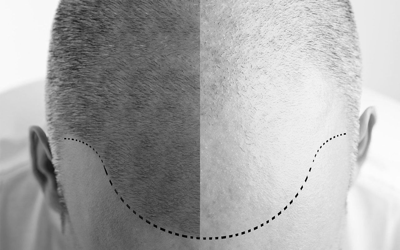 Micropigmentation